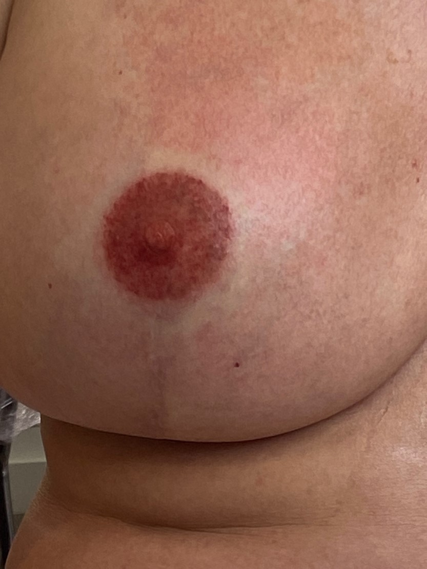Micropigmentación de areolas
